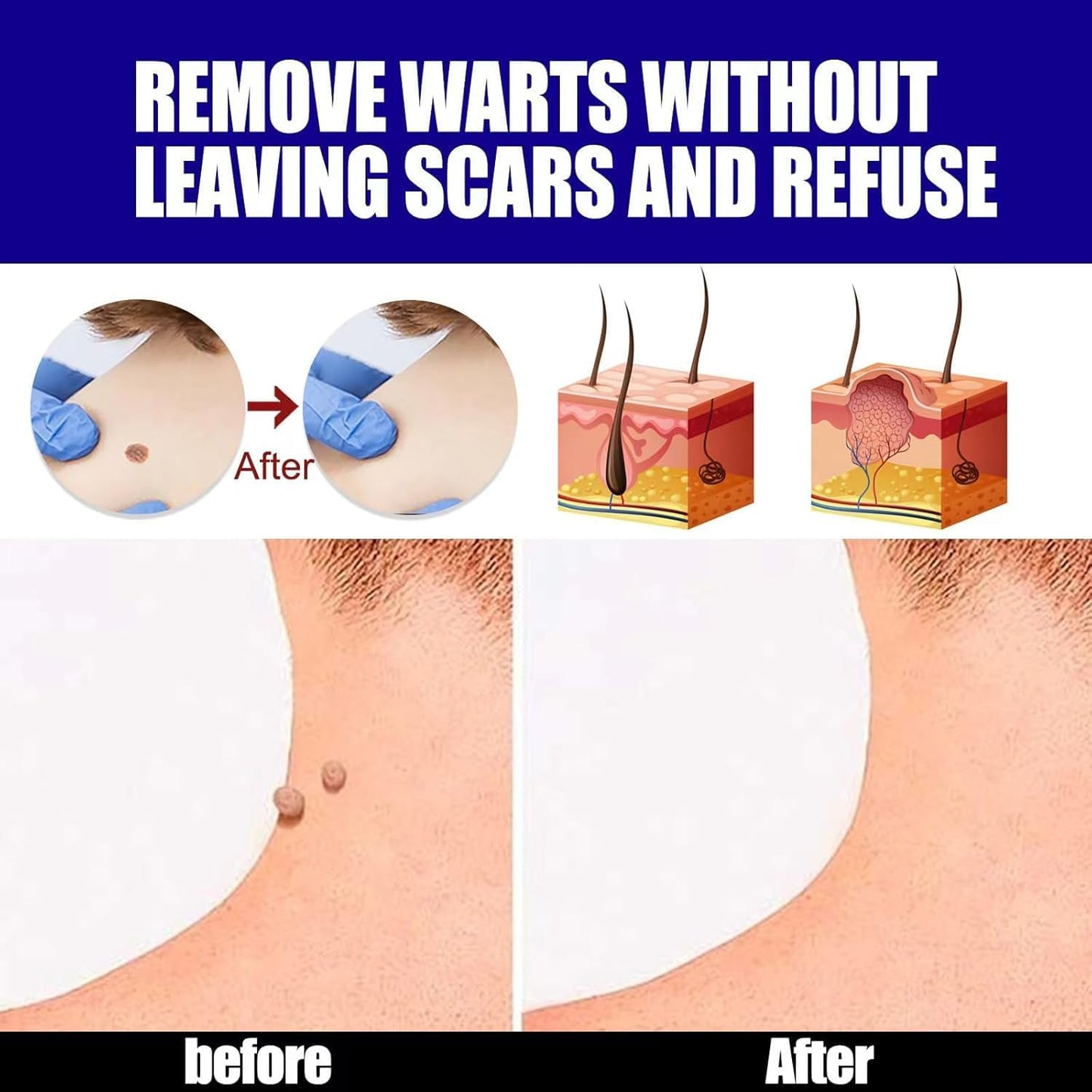 Fast-Acting Warts Remover Ointment – Natural & Painless Wart Treatment
